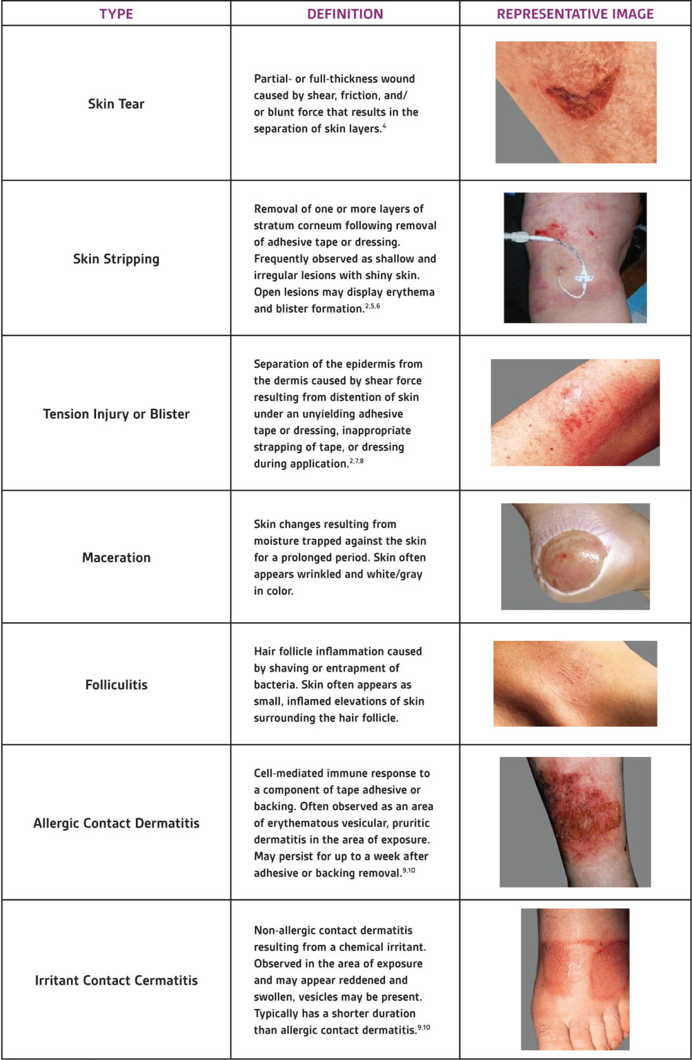 3M Dermatac Drape: Indications, Application And Clinical Pearls