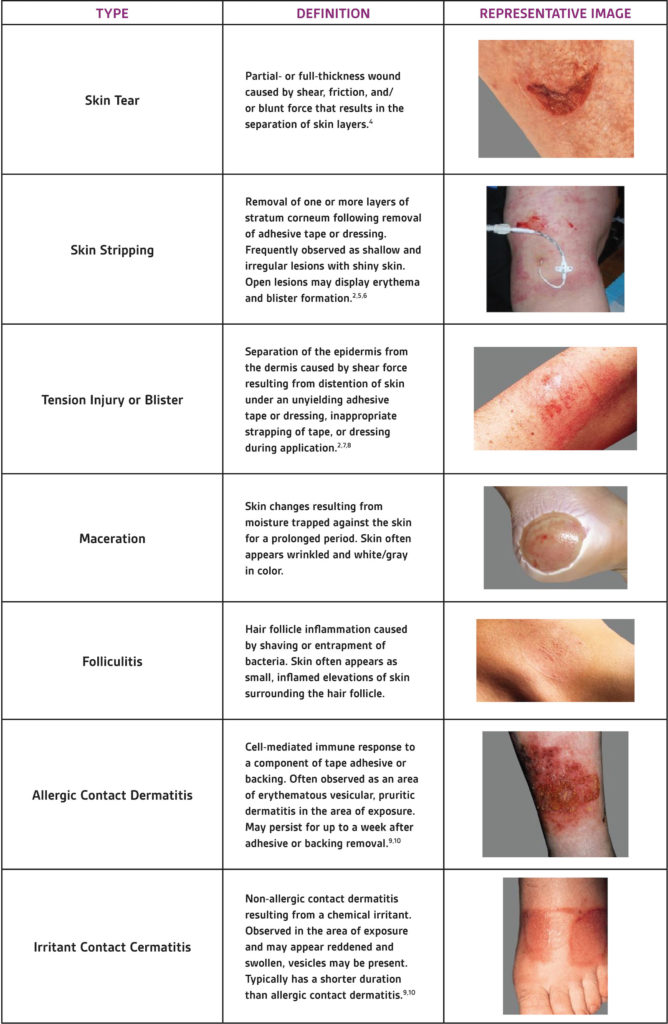 3M™ Dermatac™ Drape: Indications, Application and Clinical Pearls ...